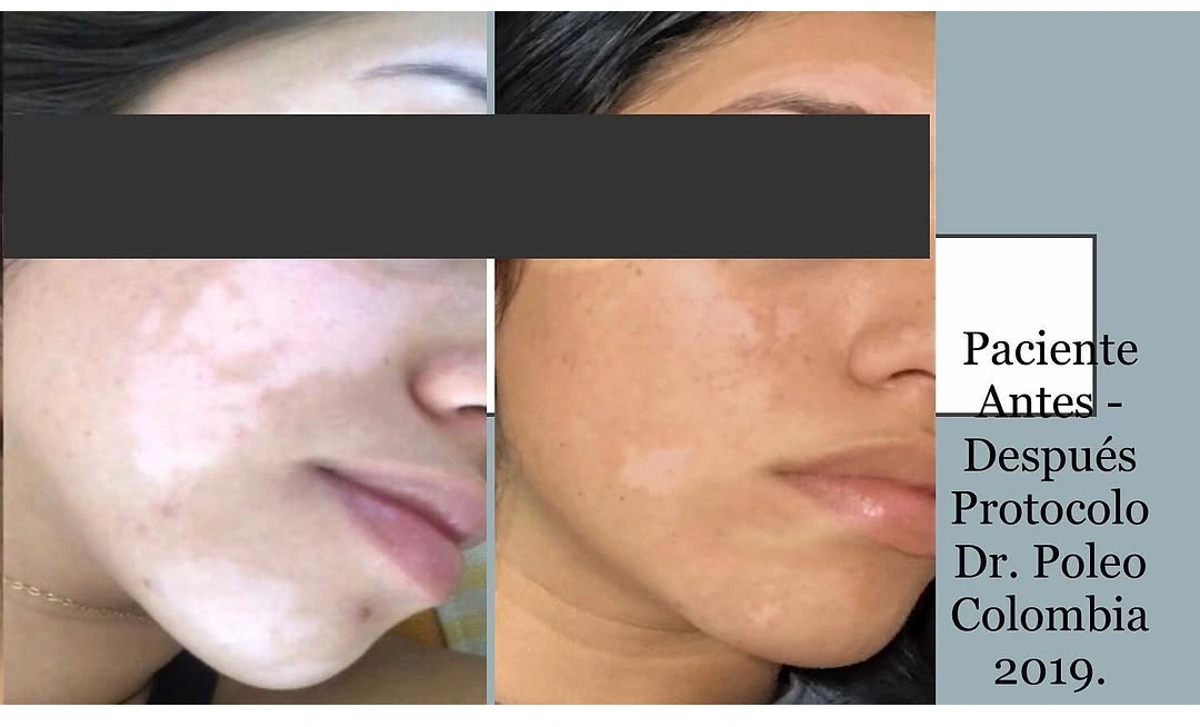 Comparativa original antes / después · Vitíligo facial