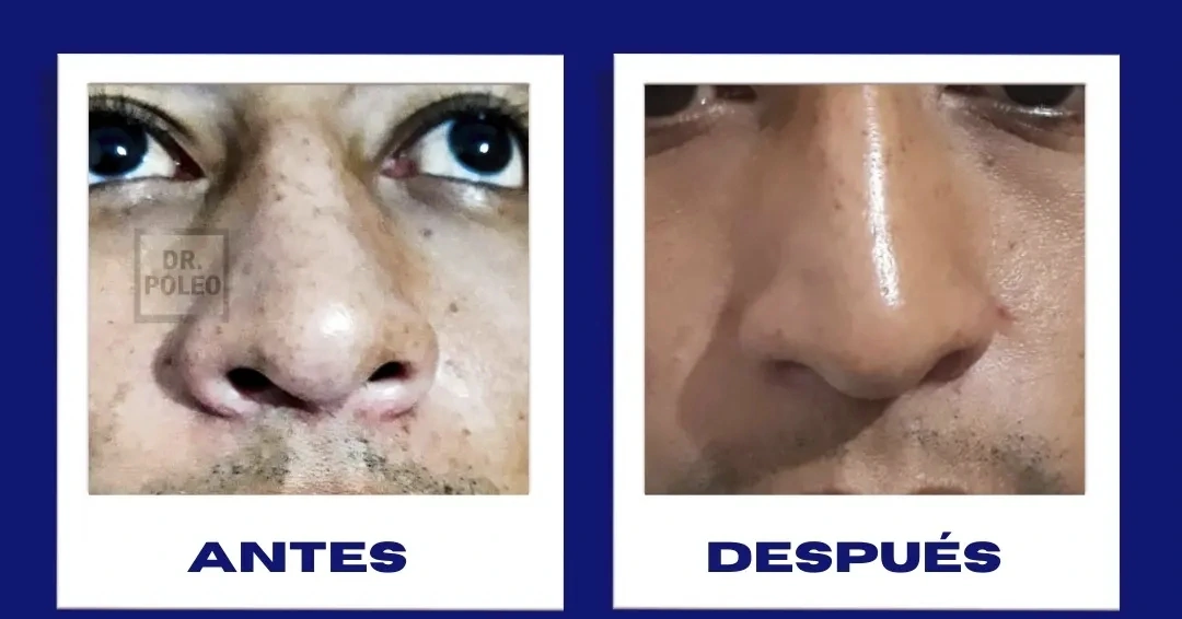 Comparativa original antes / después · Vitíligo en zona nasal