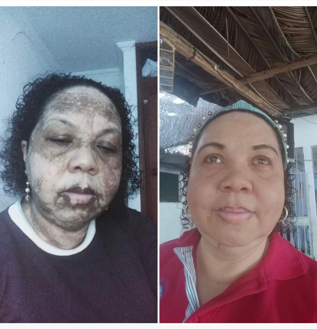 Comparativa original antes / después · Vitíligo facial