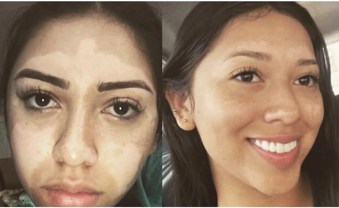 Comparativa original antes / después · Vitíligo facial