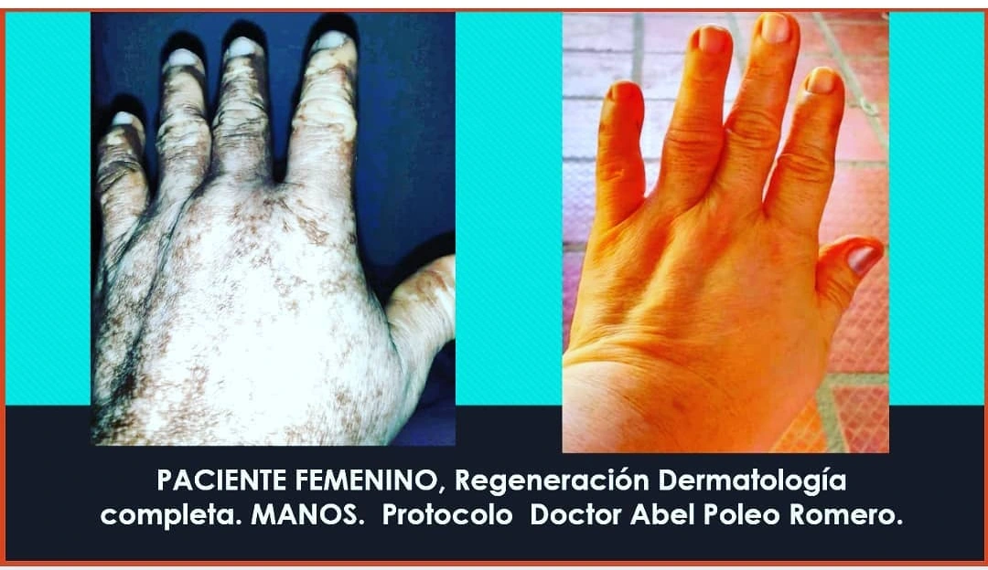 Comparativa original antes / después · Vitíligo en manos