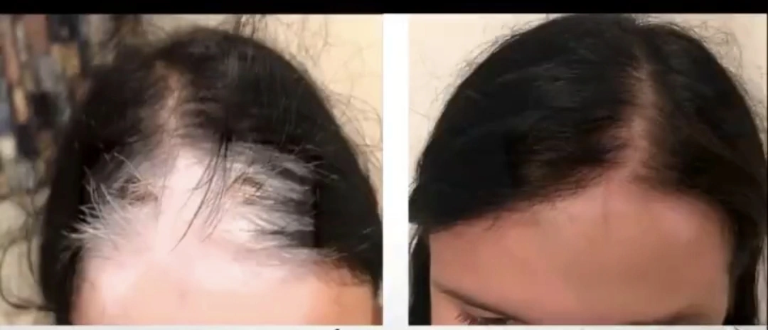 Comparativa original antes / después · Alopecia en cuero cabelludo